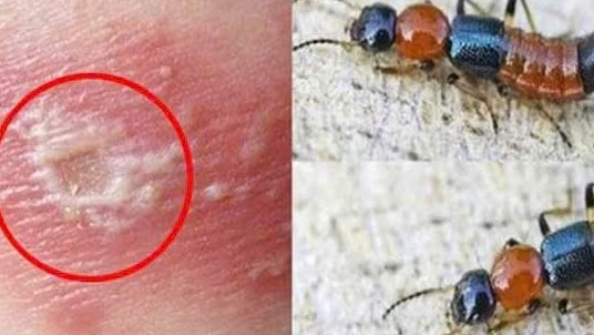 Cách phân biệt kiến ba khoang và zona thần kinh, tránh điều trị sai gây biến chứng