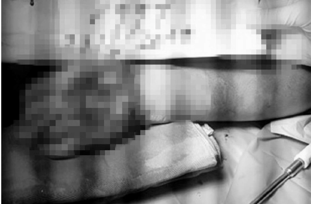 Bé trai 7 tuổi bị máy trộn bê tông cuốn nát tay khi đi chơi ở công trình