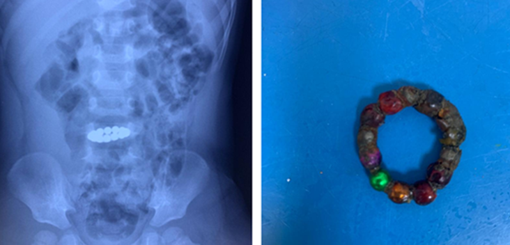 Hình ảnh dị vật trong ruột non và 14 viên bi sau khi được lấy ra. Ảnh: Bác sĩ cung cấp.