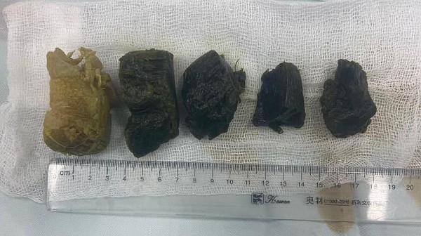 Một người đàn ông bị tắc ruột vì ăn măng khô