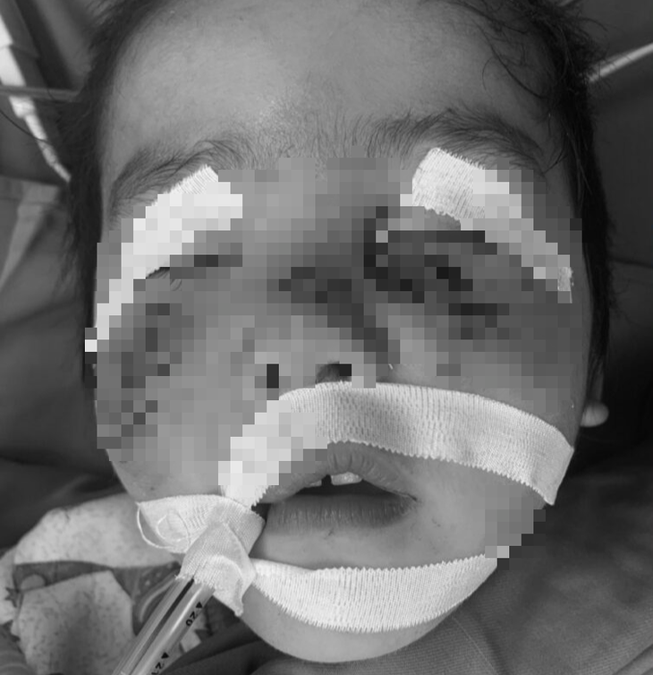 Bé H. bị rách mặt do chó cắn - Ảnh: Bệnh viện Sản nhi Phú Thọ