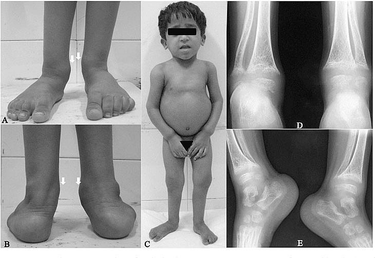 Nguyên nhân và cách phòng ngừa bệnh còi xương ở trẻ em