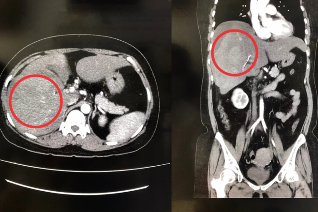Ảnh chụp CT-scan cho thấy gan phải của chị L. bị vỡ (Ảnh: BV cung cấp).