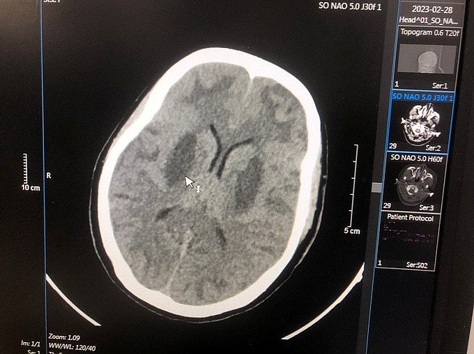Hình ảnh tổn thương não của bệnh nhân. Ảnh: BVCC.