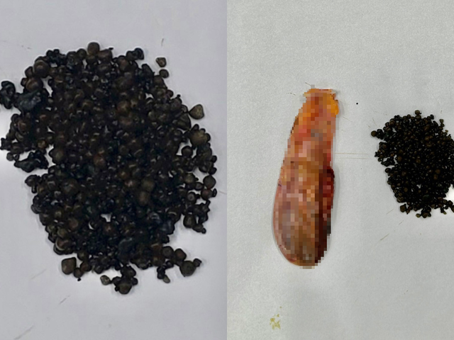 Hơn 400 viên sỏi được lấy ra từ túi mật của bệnh nhân S. Ảnh: Đình Tuyển