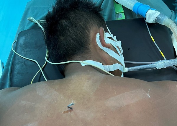 Cứu nam thanh niên bị mũi tên bắn cá xuyên vào người