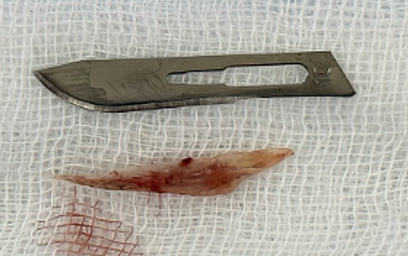Mảnh xương cá rô sau khi được lấy ra khỏi cơ thể bệnh nhân. Ảnh: BVCC.