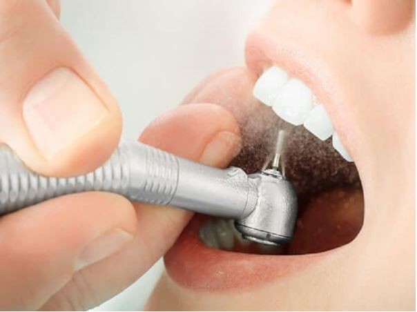 Mài răng cửa có hại không? Chi phí mài răng cửa là bao nhiêu?
