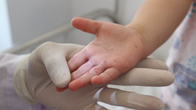 Bệnh tay chân miệng thường xuất hiện ở trẻ em dưới 5 tuổi. SỞ Y tế Đ ắ k L ắ k
