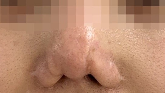 Câu chuyện “9 lần sửa mũi” và lời khuyên từ chuyên gia