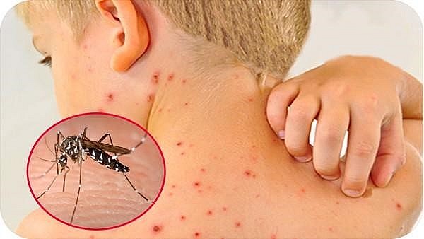 CDC Hà Nội: Dự báo dịch sốt xuất huyết trên địa bàn có xu hướng gia tăng