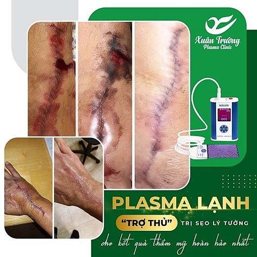 Với công nghệ Plasma lạnh máy Mirari được xem trợ thủ đắc lực trong việc làm lành vết thương và không để lại sẹo.