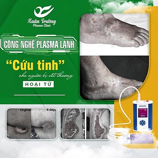 Plasma có khả năng tiêu diệt các vi sinh vật làm chậm quá trình liền vết thương do đó các vết thương hở, hoại tử được làm lành nhanh chóng.