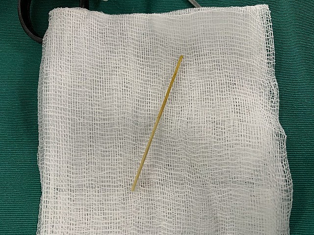 Hình ảnh chiếc tăm dài gần 7 cm trong đại tràng bệnh nhân