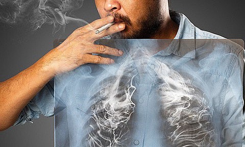 Ung thư phổi và những điều cần biết