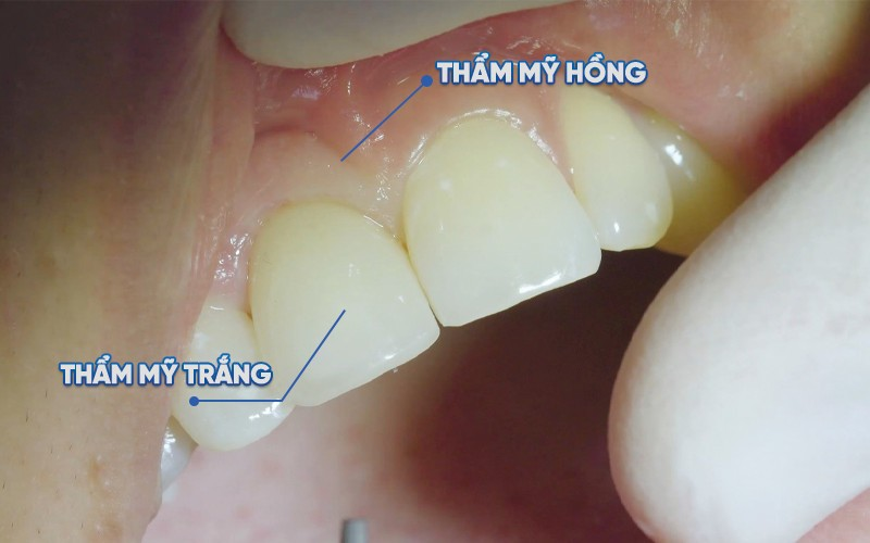 Công nghệ DCT - Bước đột phá trong công nghệ phục hình răng Implant