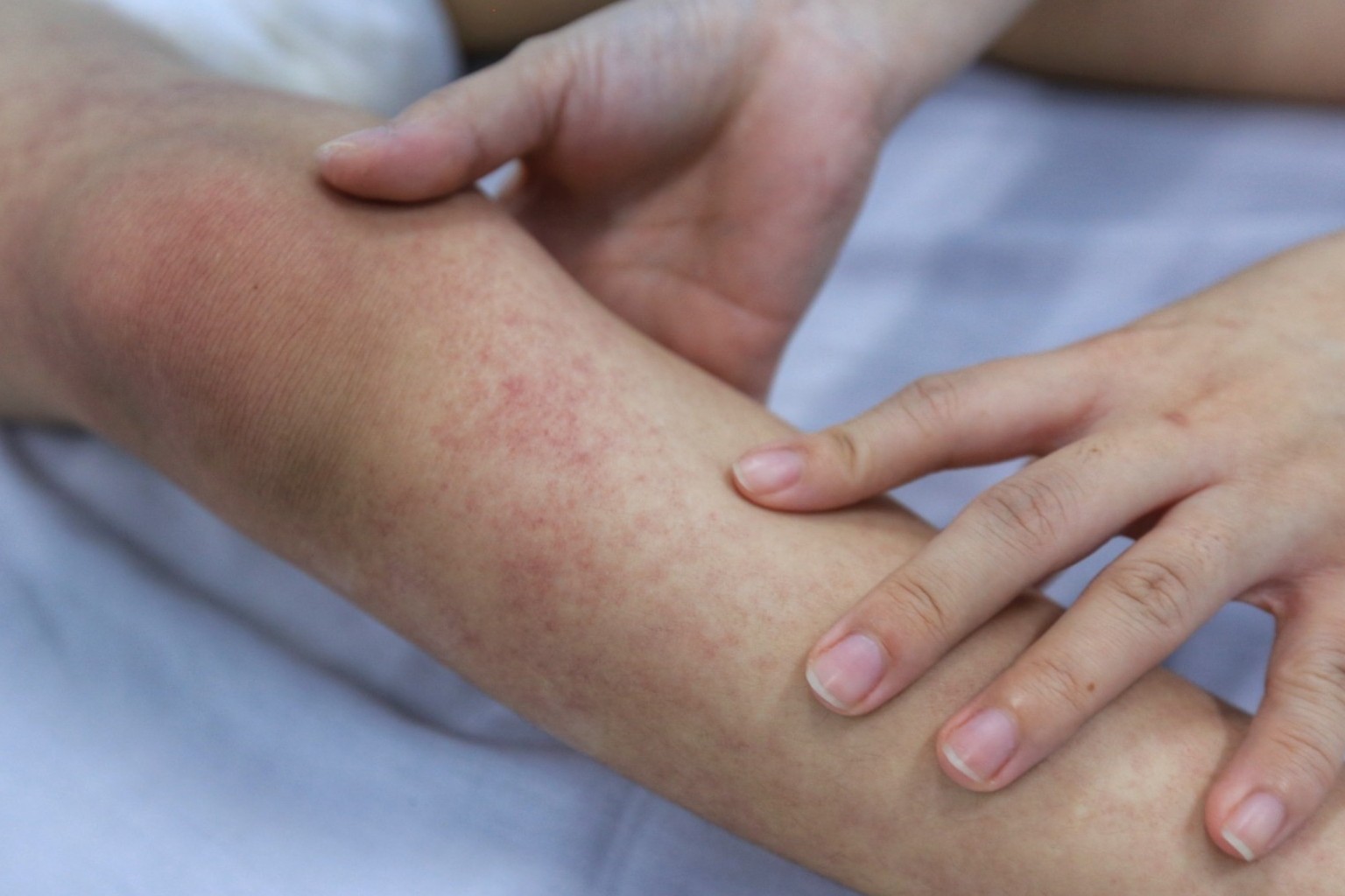 Chế độ dinh dưỡng cho người mắc sốt xuất huyết