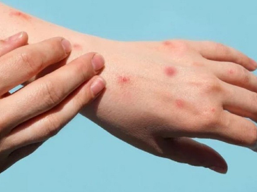6 khuyến cáo phòng bệnh đậu mùa khỉ của Bộ Y tế