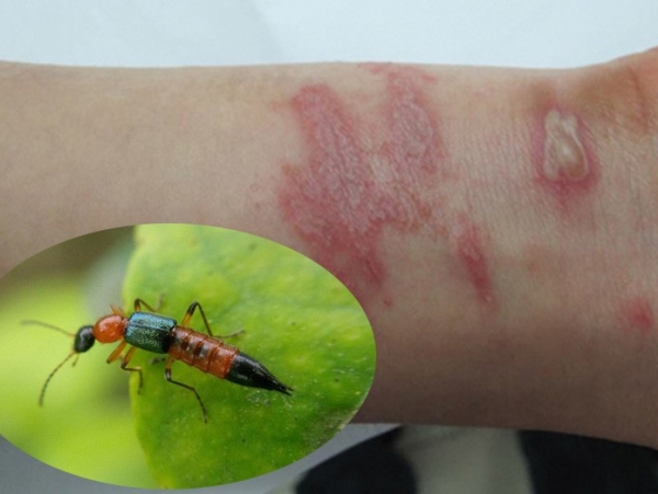 Phòng tránh viêm da tiếp xúc do dính độc của kiến ba khoang