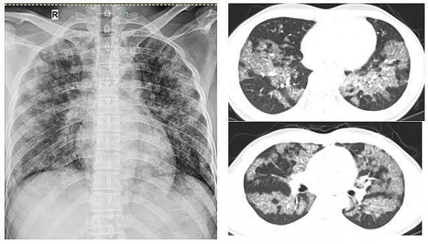 Bệnh viên đa khoa tỉnh Phú Thọ: Điều trị ca bệnh tích tụ protein phế nang hiếm gặp bằng phương pháp rửa phổi