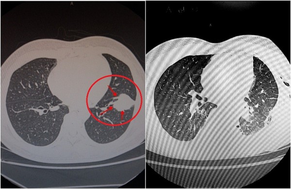 Hút thuốc lào gần 30 năm: Người đàn ông phát hiện mắc ung thư phổi