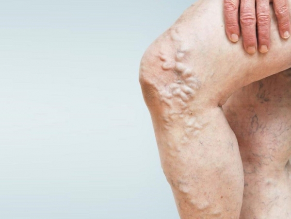 Hướng dẫn điều trị dự phòng thuyên tắc huyết khối tĩnh mạch