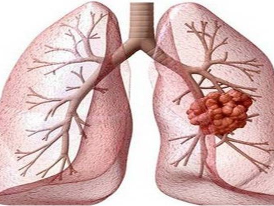 Khuyến cáo tầm soát phát hiện sớm ung thư phổi