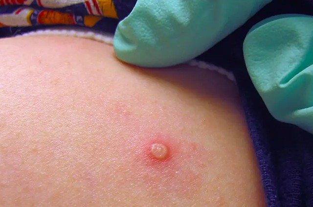 Thông tin về bệnh nhân đậu mùa khỉ tử vong ở TPHCM