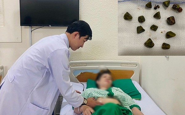 Đồng Nai: Nữ bệnh nhân viêm túi mật cấp vì hàng chục viên sỏi