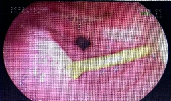 Đồng Nai: Nuốt cây tăm dài 4,5cm vào bụng, nữ bệnh nhân phải nhập viện cấp cứu