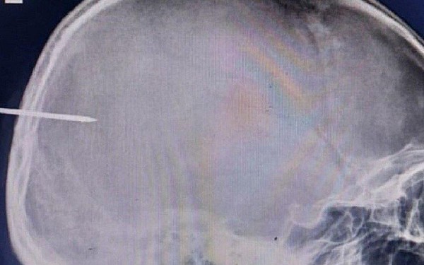 Quảng Ninh: Chàng trai nhập viện với chiếc đinh sắt cắm trên đầu