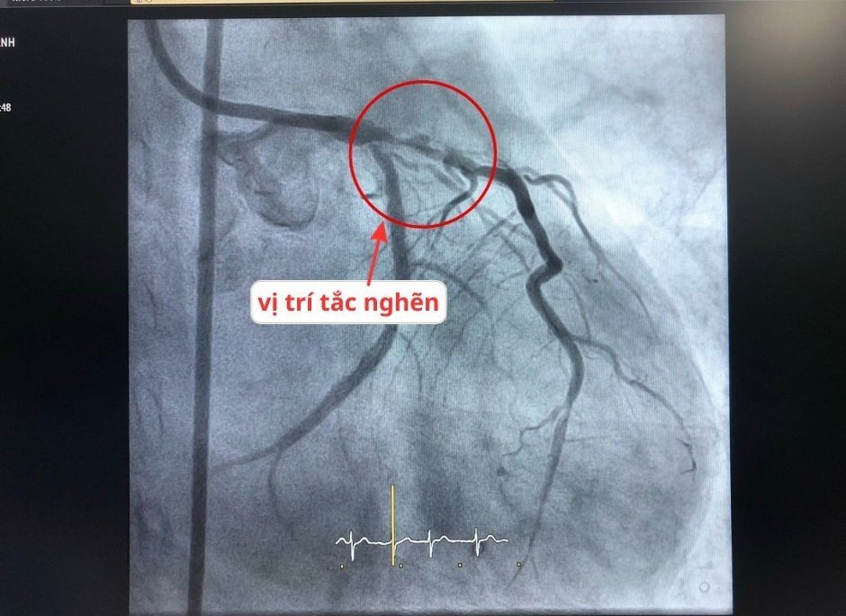 Căng não đặt 2 stent cứu sống bệnh nhân tái phát hẹp mạch vành tại vị trí khó