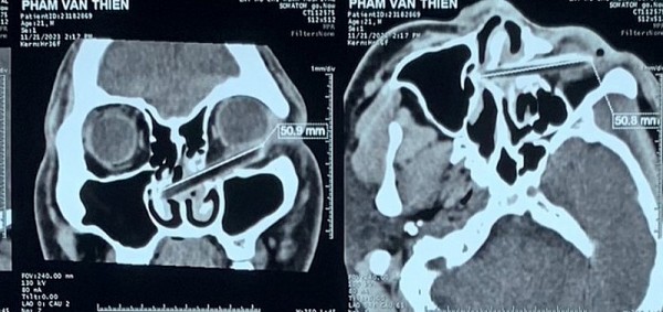 Chàng trai bị kẻ ngáo đá dùng đũa đâm xuyên hốc mắt khi đang đi trên đường