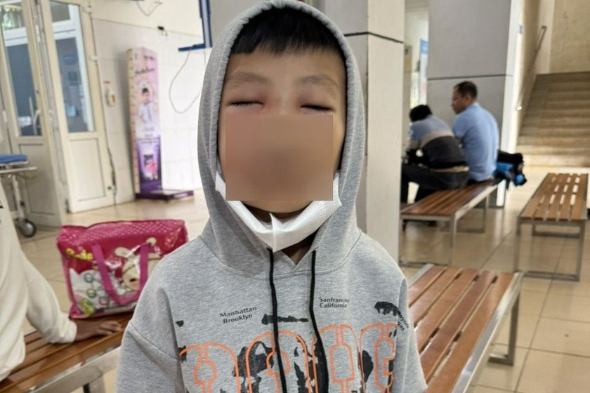 Thanh Hóa: Bé trai 8 tuổi sưng nề mặt sau điều trị đau răng tại phòng khám tư