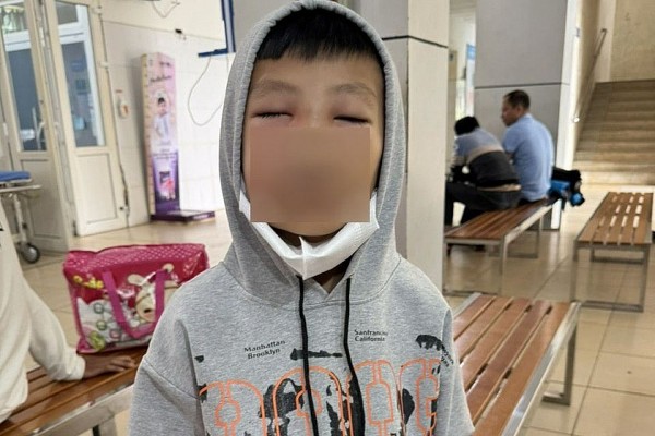 Thanh Hóa: Bé trai 8 tuổi sưng nề mặt sau điều trị đau răng tại phòng khám tư