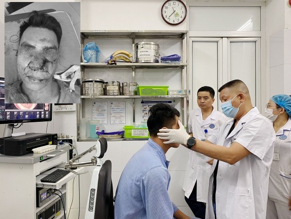Phẫu thuật thành công xương vùng mặt bị vỡ cho bệnh nhân tai nạn giao thông