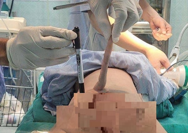 Thanh Hóa: Cắt bỏ thành công đuôi dị tật bẩm sinh dài 14 cm cho bệnh nhi 4 tháng tuổi