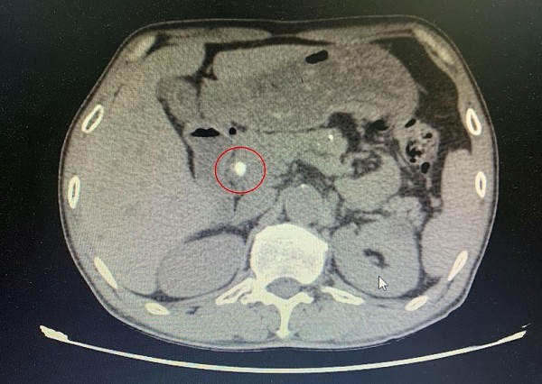 Quảng Ninh: Phẫu thuật nội soi lấy sỏi ống mật chủ cho bệnh nhân