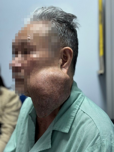 Phẫu thuật thành công lấy khối u tuyến dưới hàm cho bệnh nhân cao tuổi