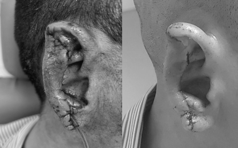 Bệnh viện Quân y 103: Xử lý tai dập nát, mất sụn cho bệnh nhân bị tai nạn giao thông