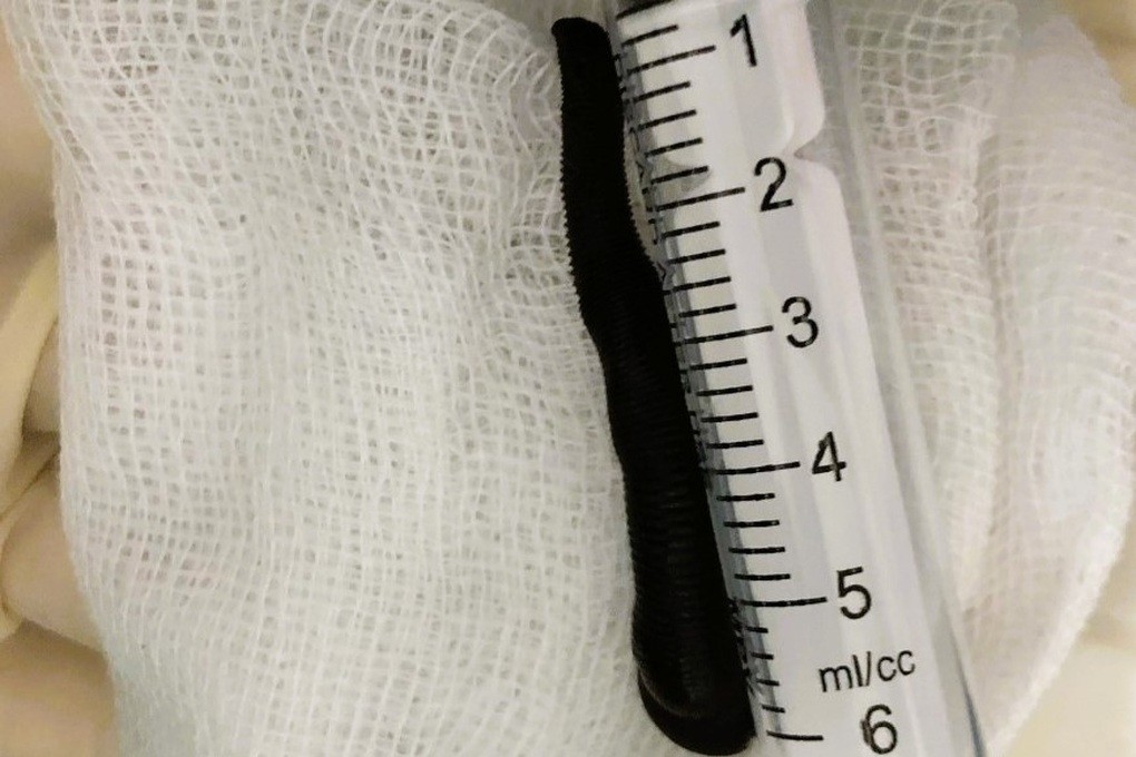 Nghệ An: Phát hiện đỉa dài hơn 6cm sống trong khí quản bệnh nhân