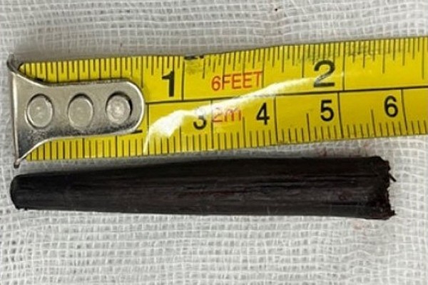 Bình Dương: Bệnh nhân bị đũa gỗ dài gần 6 cm đâm sâu vào hốc mắt