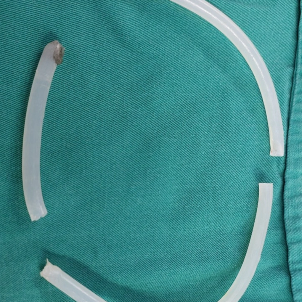 Hy hữu: Cấp cứu người đàn ông nhét cây keo nến dài 40 cm vào niệu đạo