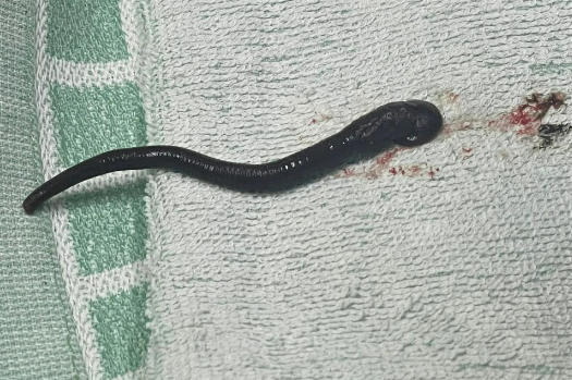 Con vắt dài gần 7 cm sống trong mũi người phụ nữ