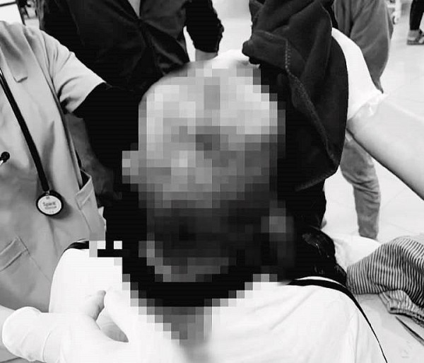 Người phụ nữ bị lột rời toàn bộ da đầu vì tóc cuốn vào máy sao chè