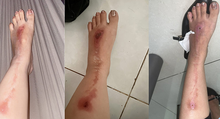 TP HCM: Người phụ nữ bị bỏng nặng do bắn pháo hoa mừng tiệc tất niên