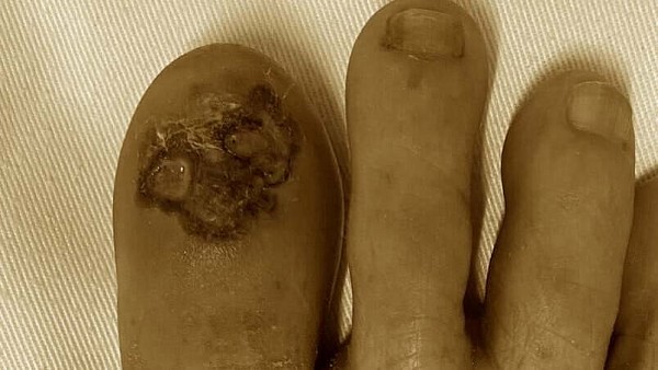 Bệnh nhân phát hiện ung thư da từ vết loét ở móng chân