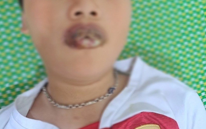 Hải Phòng: Bé 11 tuổi phải nhập viện do gia đình tự ý dùng thuốc điều trị tại nhà