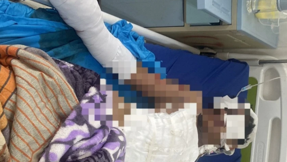 Đắk Nông: Tự chế tạo pháo, nam sinh bị thương nặng