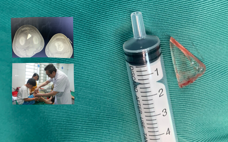 Nghệ An: Loại bỏ mảnh vỡ thủy tinh nằm trong đầu gối bé trai gần 2 năm